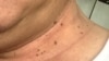 Thịt dư da (Skin tags).